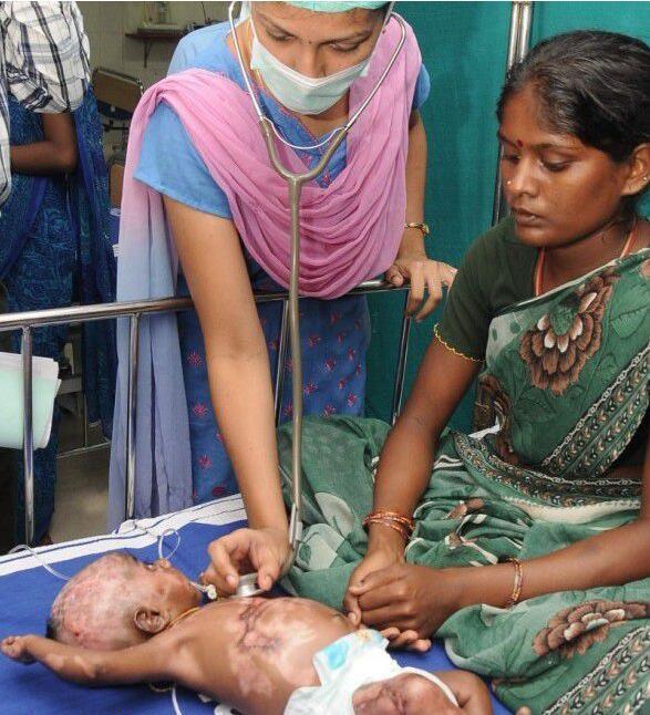 印度男婴患“人体自燃症